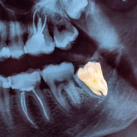 yuba city dental extractions|Yuba City Dentistry .